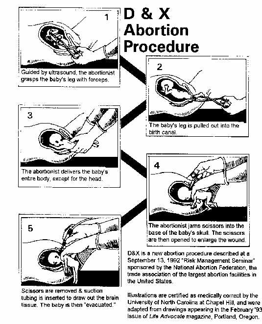 Partial  Birth Abortion